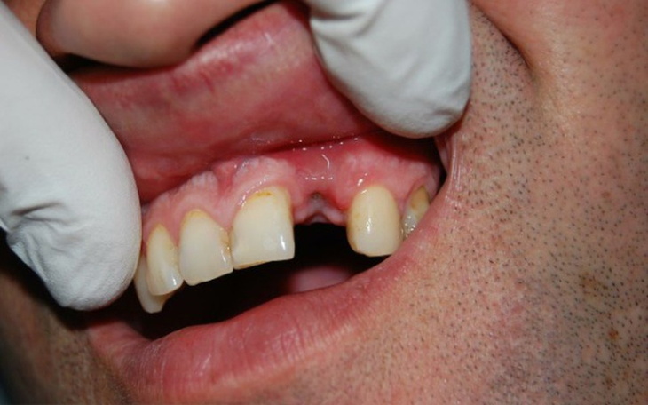 Zbiórka Nowy ząb -w końcu będzie uśmiech - zdjęcie główne