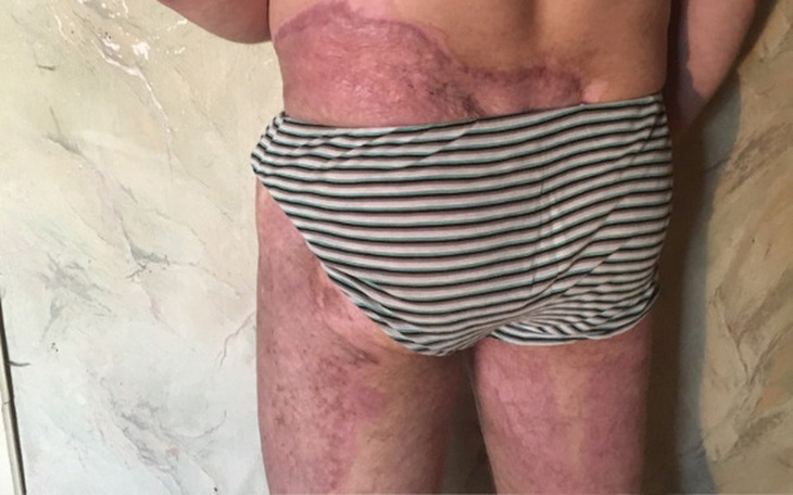 Zbiórka Na leczenie blizn poparzeniowych - zdjęcie główne