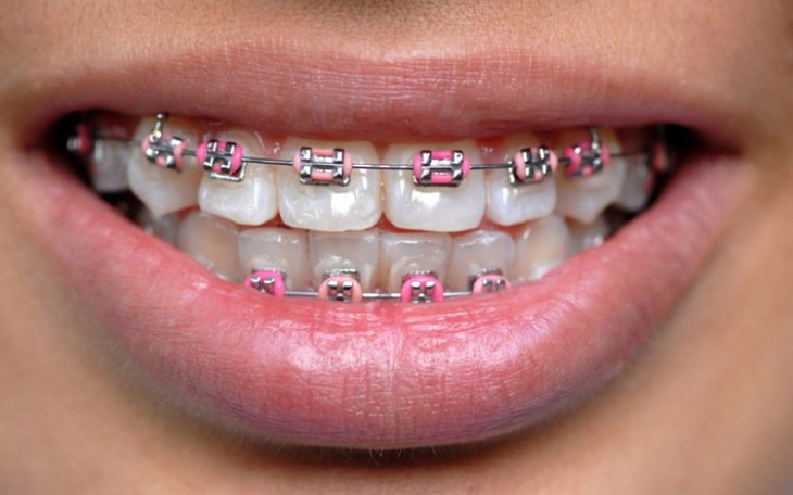 Zbiórka Aparat ortodontycznyyy - zdjęcie główne