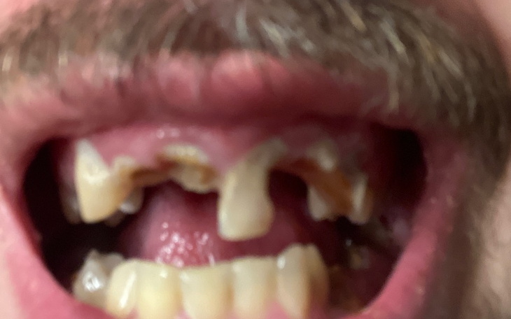 Zbiórka Na sztuczne zęby dla 24 latka - zdjęcie główne