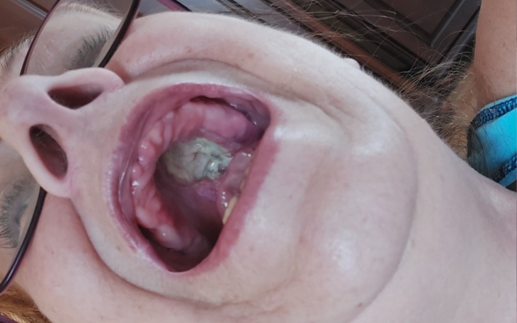 Osoba pokazująca wnętrze jamy ustnej.