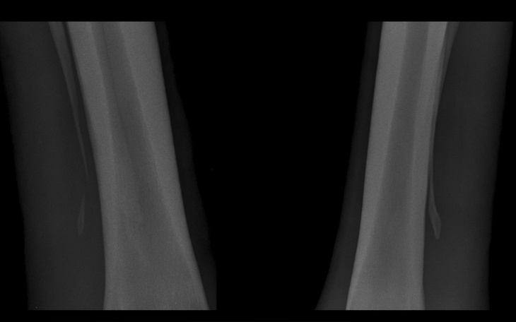 Zbiórka Operacja złamania - pomóż Zoji - zdjęcie główne