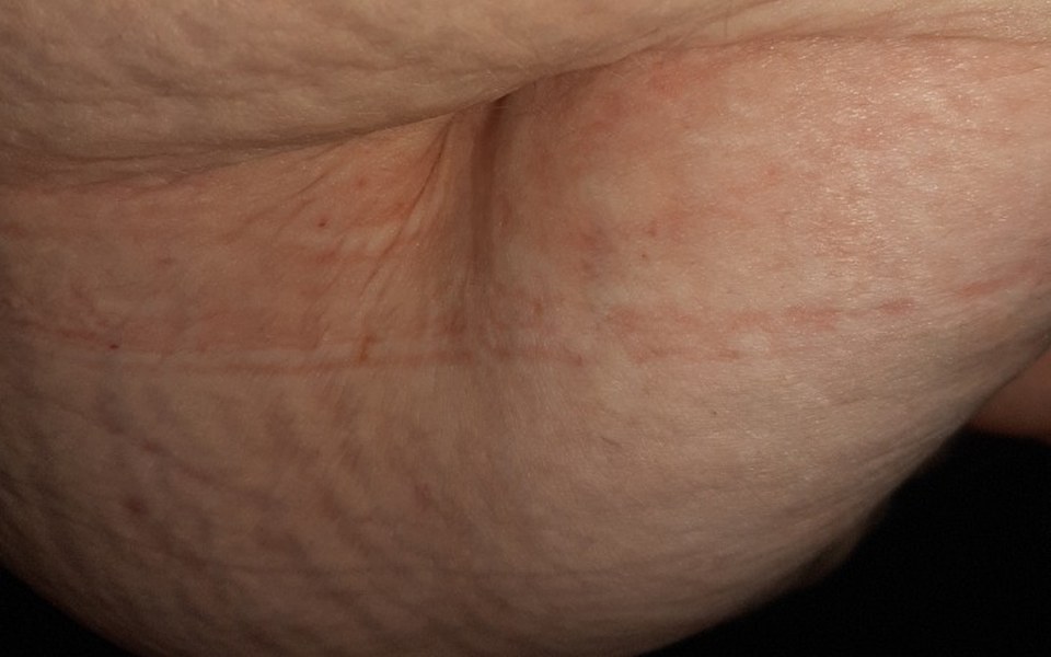 
        Zbiórka Abdominoplastyka brzucha - zdjęcie główne
    