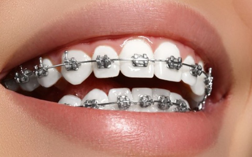 
        Uśmiechnięta osoba z aparatami ortodontycznymi na zębach.
    