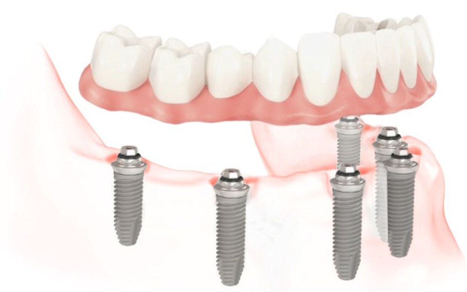 
        Zbiórka Metoda All-on-4 - zdjęcie główne
    