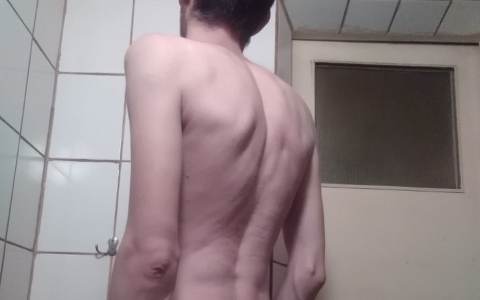 
        Zbiórka Cel operacja na wadę postawy - zdjęcie główne
    