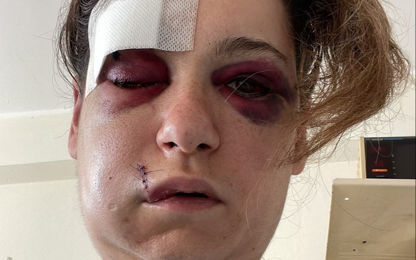 
        Osoba z bandażem na głowie i sinym okiem, chłodna kliniczna sceneria
    