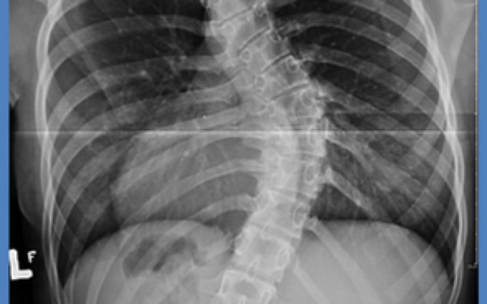 
        Zbiórka Leczenie skoliozy kręgosłupa - zdjęcie główne
    