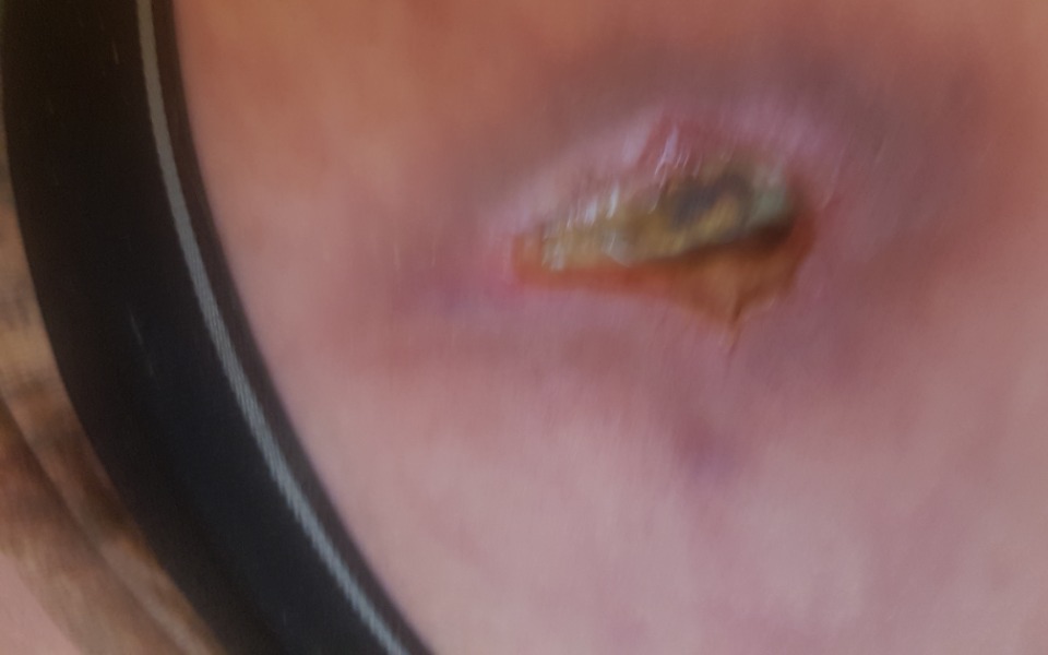 
        Zbiórka Zbiórka na stopę cukrzycową - zdjęcie główne
    