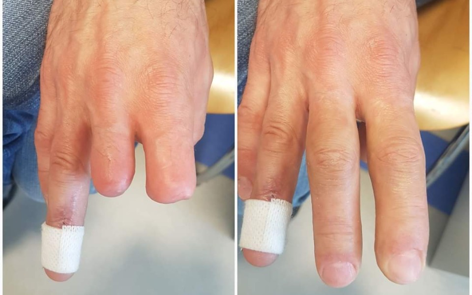 
        Zbiórka Silikonowa proteza paliczków - zdjęcie główne
    