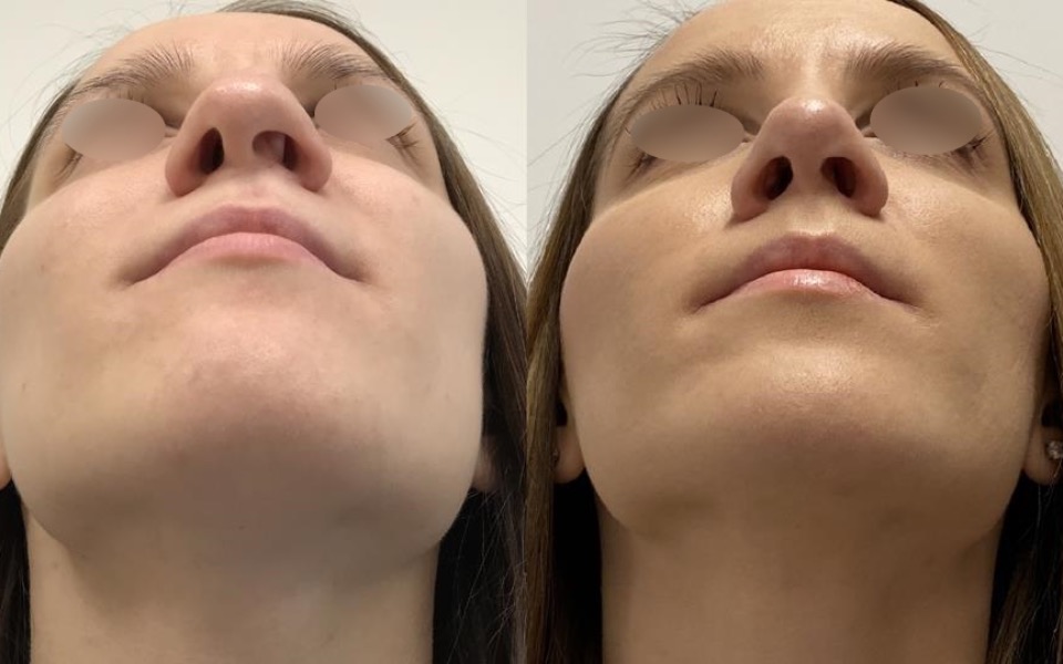 
        Zbiórka Rynoplastyka Nosa - zdjęcie główne
    