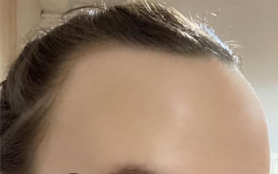 
        Zbiórka Na przeszczep wlosow - zdjęcie główne
    