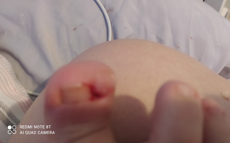 
        Zbiórka Wrośnięty paznokieć - zdjęcie główne
    