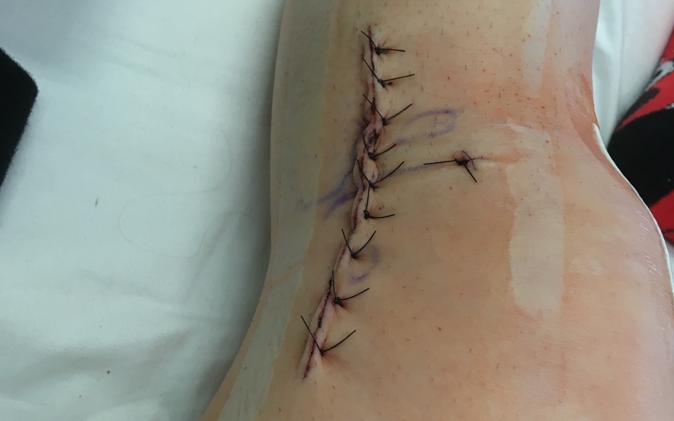 
        Zbiórka Na Rehabilitacje po 3 operacjach - zdjęcie główne
    