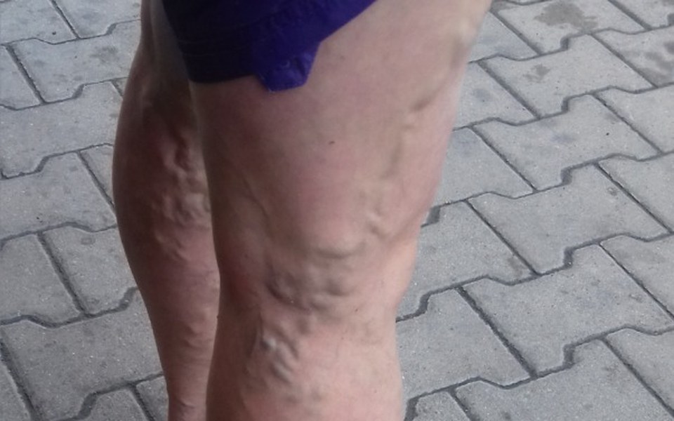 
        Zbiórka Operacja na   nogi  (Żylaki) - zdjęcie główne
    