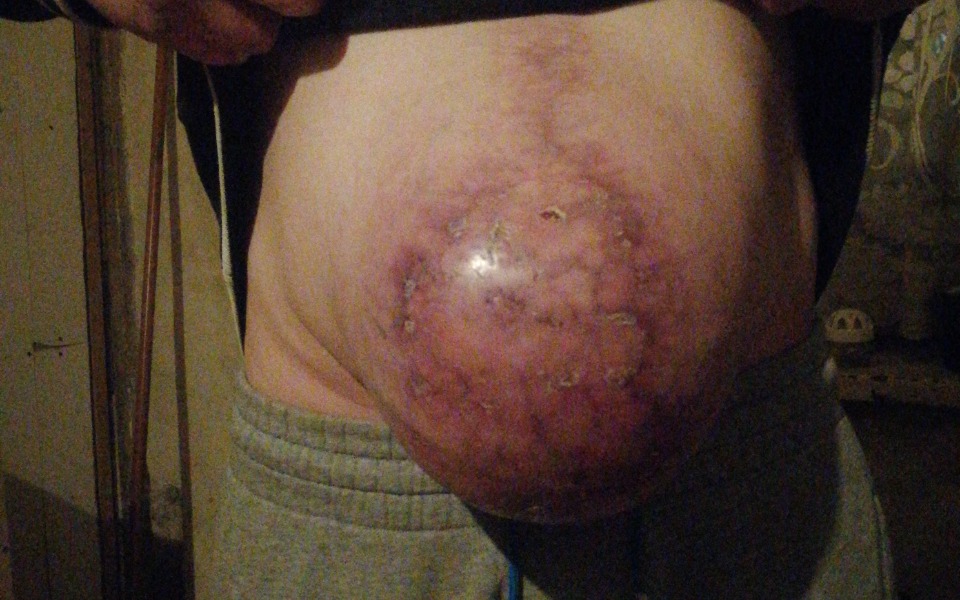 
        Zbiórka Operacja Przepukliny Pooperacyj - zdjęcie główne
    