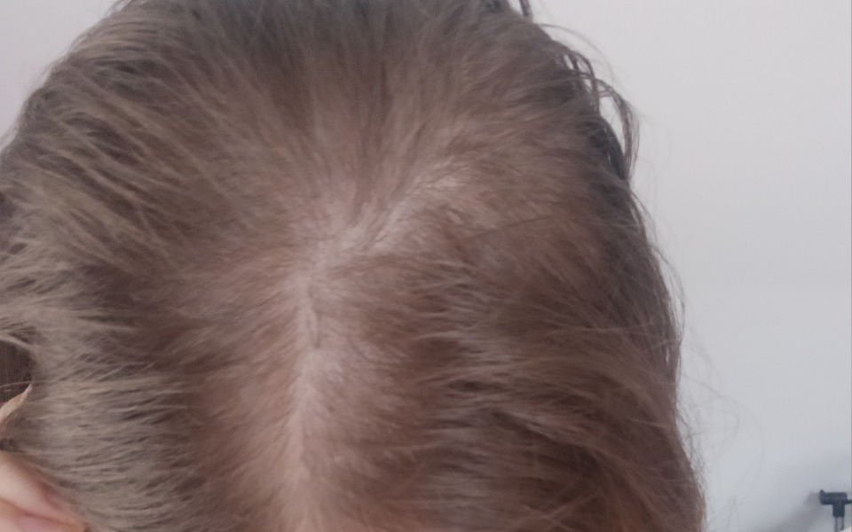 
        Zbiórka Na leczenie androgenowe i zabieg - zdjęcie główne
    