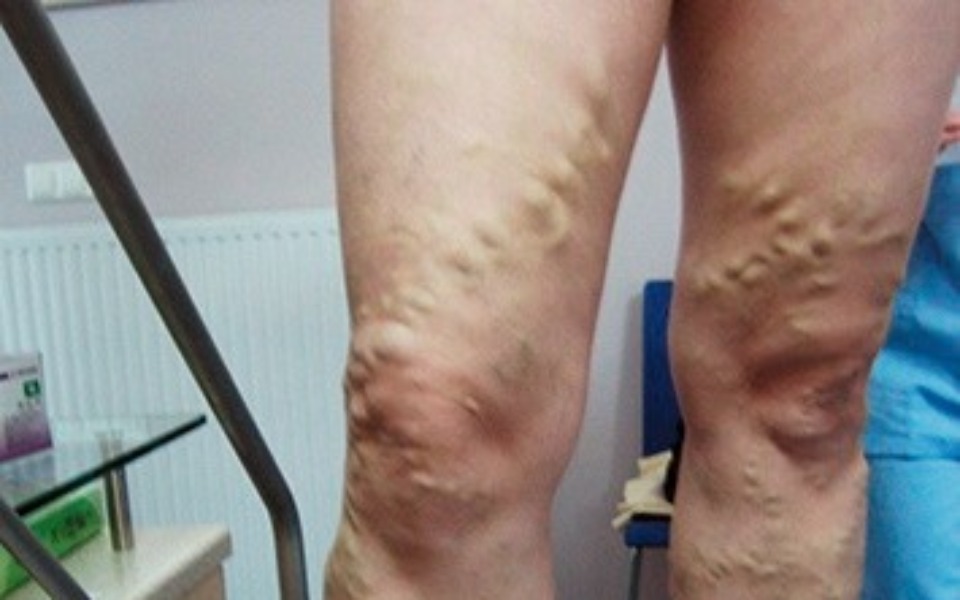 
        Zbiórka Leczenie chorych kończyn dolnych - zdjęcie główne
    