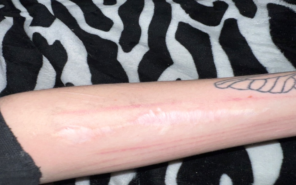 
        Zbiórka Leserowe usunięcie blizny - zdjęcie główne
    