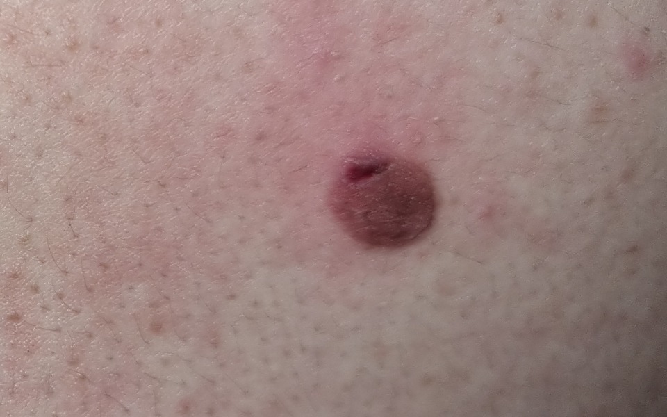 
        Zbiórka Na wizytę u dermatologa - zdjęcie główne
    