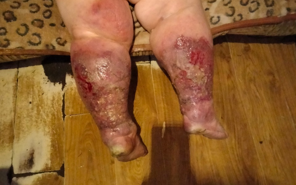 
        Zbiórka Leczenie owrzodzeń z ranami - zdjęcie główne
    