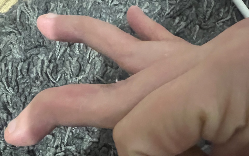 
        Zbiórka Operacja zdeformowania palców - zdjęcie główne
    