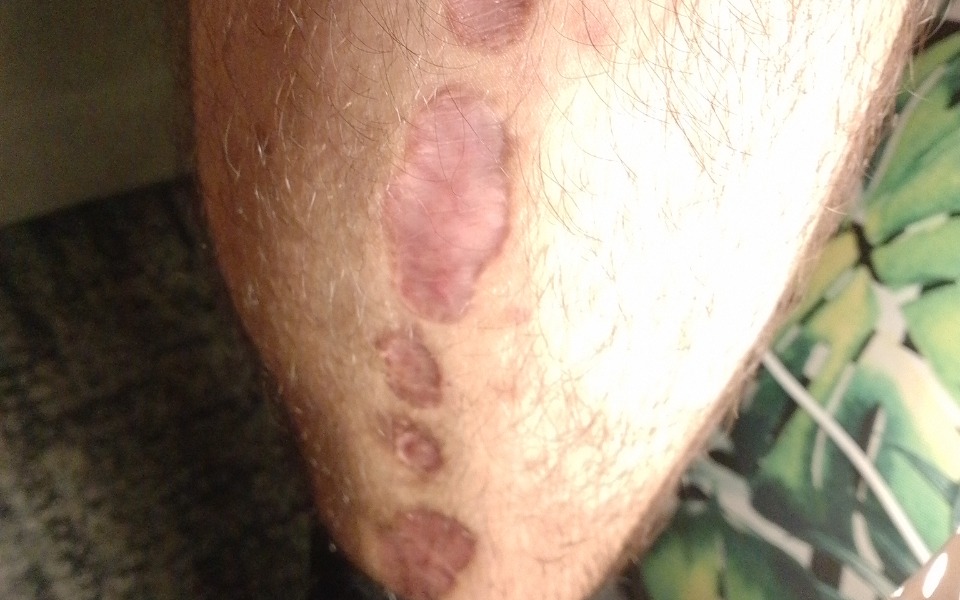 
        Zbiórka Leczenie nowotworu raka kości - zdjęcie główne
    