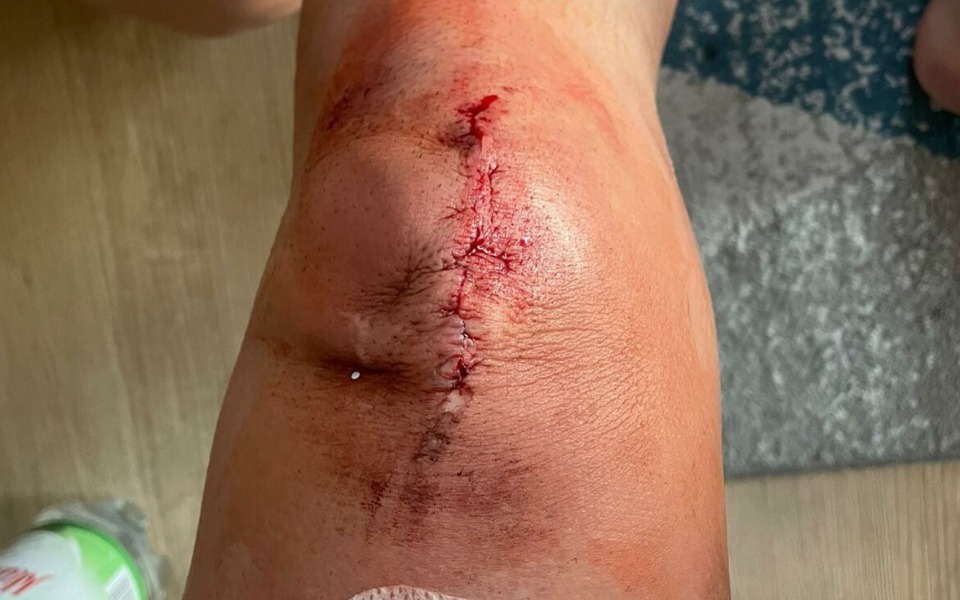 
        Zbliżenie na ranę pooperacyjną na kolanie.
    