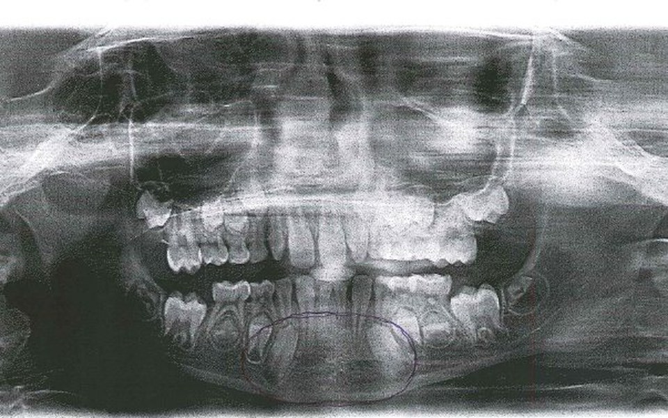 
        Zbiórka uzupełnienie uzębienia córki - zdjęcie główne
    