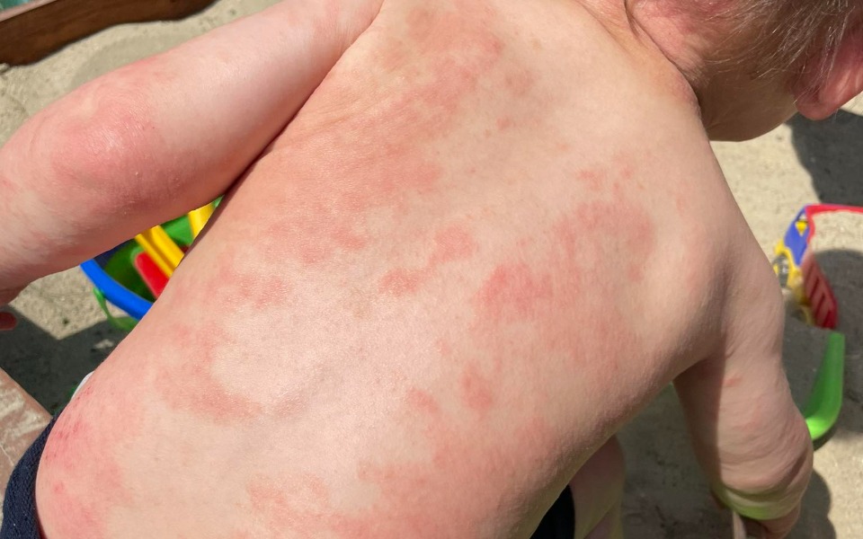 
        Zbiórka Testy na alergie, kremy, opatrun - zdjęcie główne
    