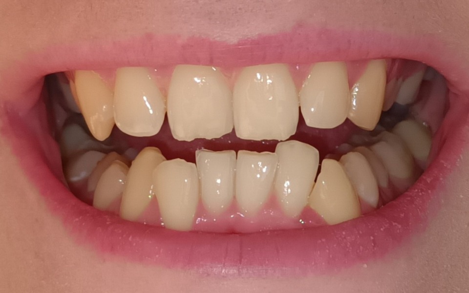 
        Zbiórka Założenie aparatu na zęby - zdjęcie główne
    