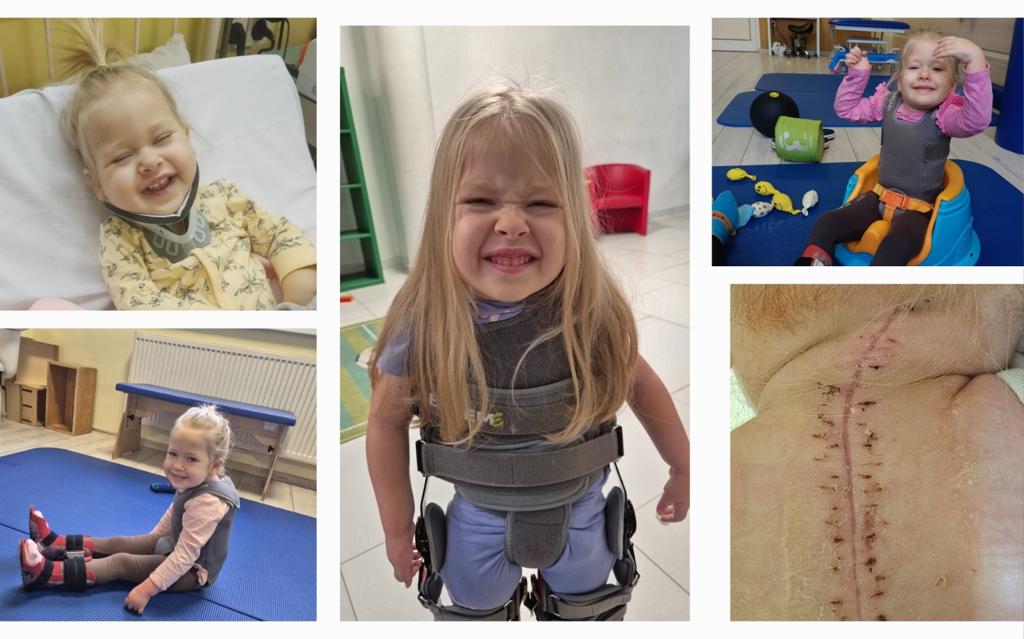 
        Uśmiechnięta dziewczynka w rehabilitacji, z uśmiechem.
    