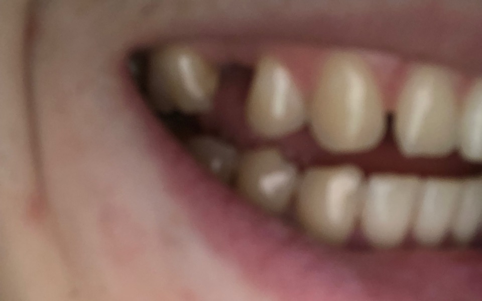 
        Zbiórka Wstawienie sztucznego zęba - zdjęcie główne
    