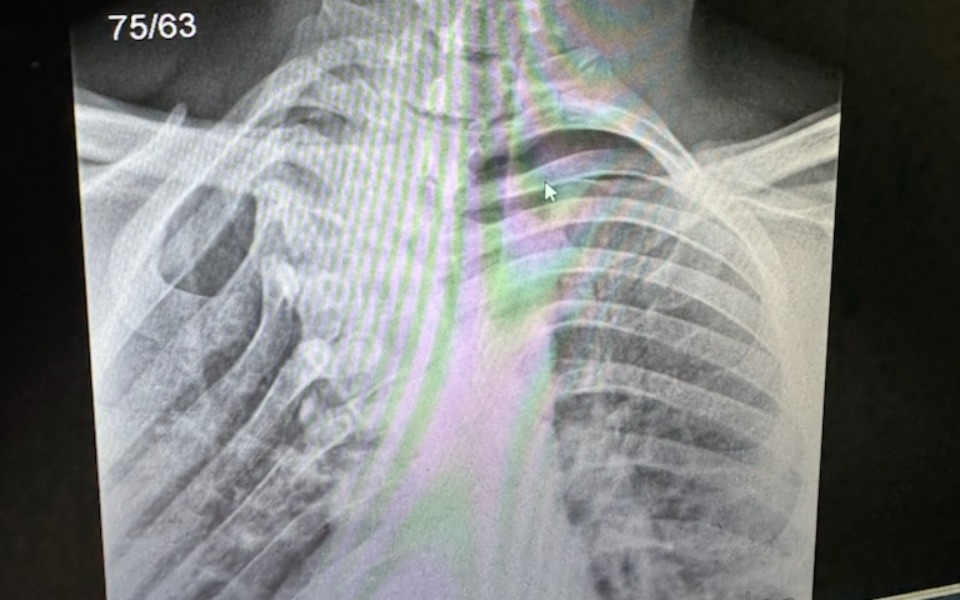 
        Zbiórka operacja skreconego kręgosłupa - zdjęcie główne
    