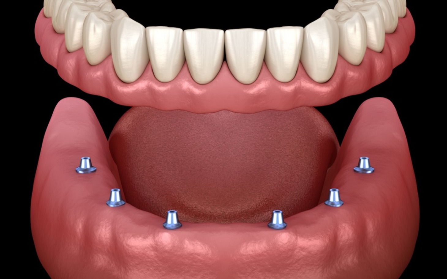 
        Model szczęki z implantami, przedstawiający szczegóły stomatologiczne.
    