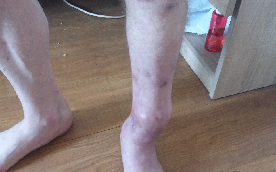 
        Zbiórka Prosze o pomoc na leczenie nogi - zdjęcie główne
    