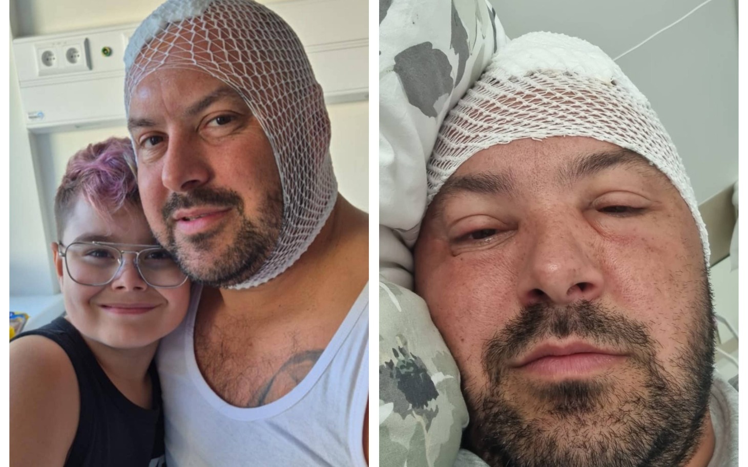 
        Mężczyzna z siatką na głowie, zdjęcie po operacji.
    