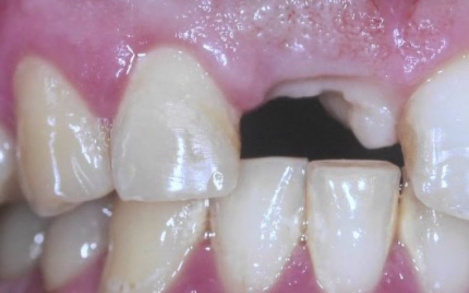 
        Zbiórka leczenie_protetyczne - zdjęcie główne
    