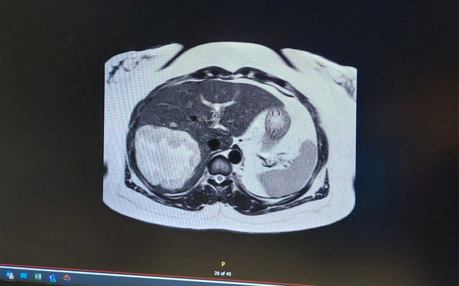 
        Obraz MRI klatki piersiowej, przedstawiający narządy wewnętrzne.
    