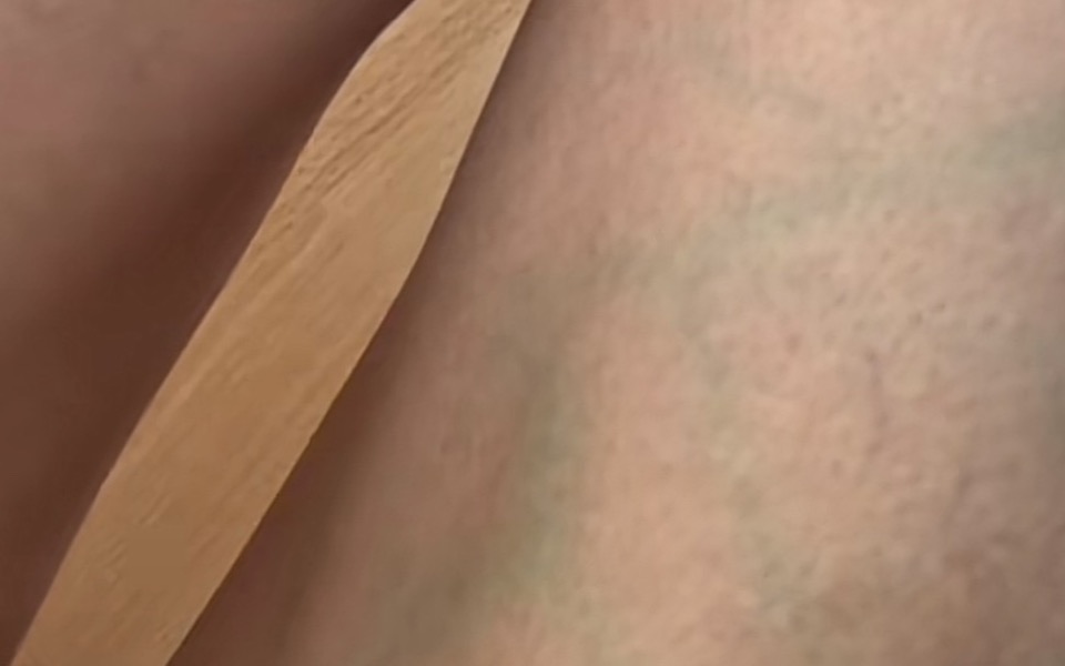 
        Zbiórka Leczenie żylaków skleroterapią - zdjęcie główne
    