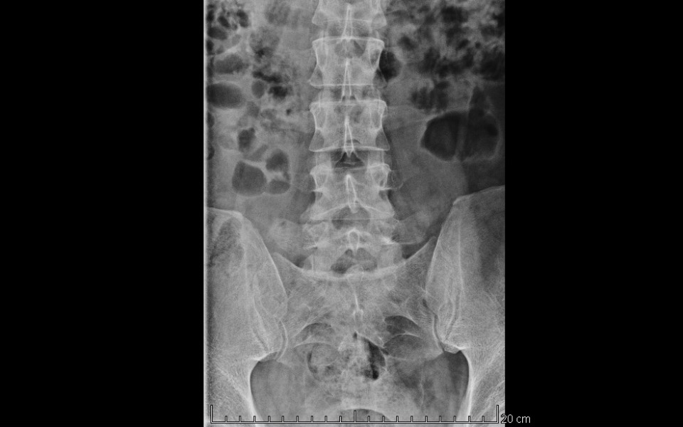 
        Zdjęcie rentgenowskie kręgosłupa, pokazujące struktury kostne.
    