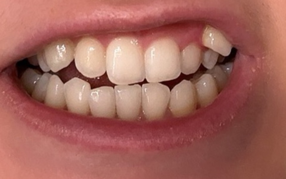 
        Zbiórka na aparat ortodontyczny braces - zdjęcie główne
    