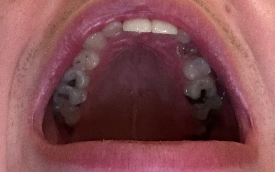 
        Otwarte usta z widocznymi zębami, w tym próchnicą.
    