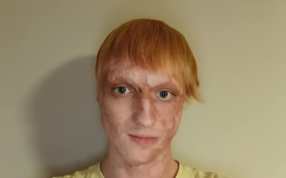 
        Młody mężczyzna z rudymi włosami i bliznami na twarzy.
    