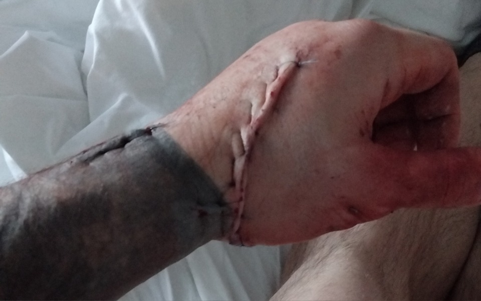 
        Ręka z widocznymi szwami po operacji.
    