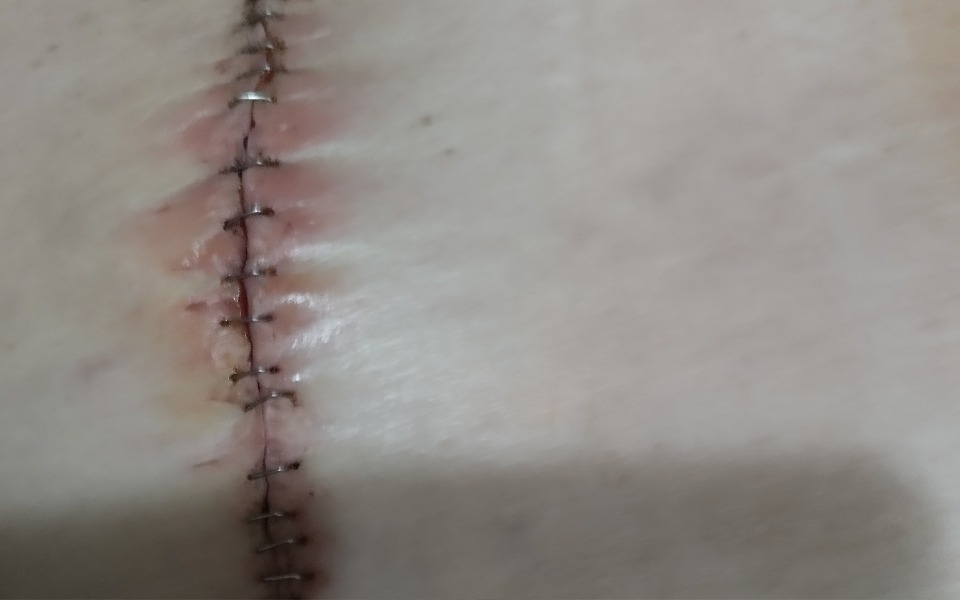 
        Blisko zdjęcie blizny na skórze, po operacji.
    