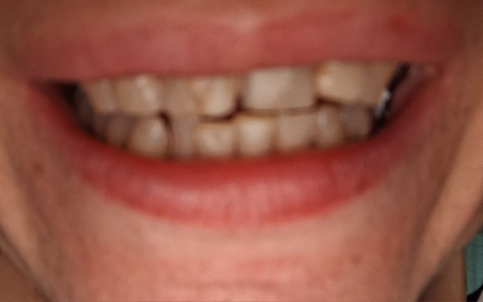 
        Zbliżenie na uśmiech z widocznymi zębami.
    