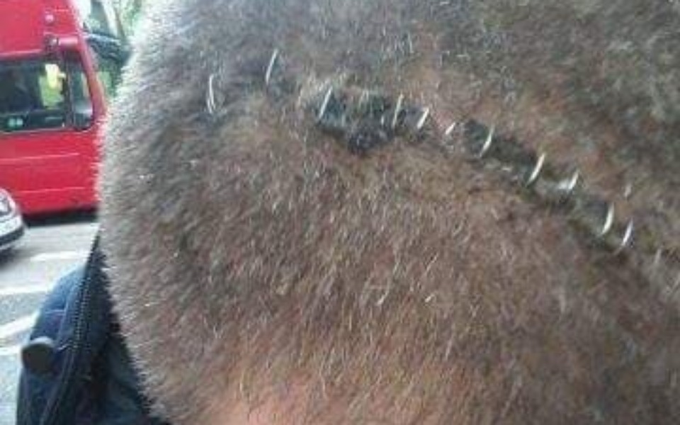 
        Mężczyzna z nietypowym wzorem na głowie, wygląda na kontuzjowanego.
    