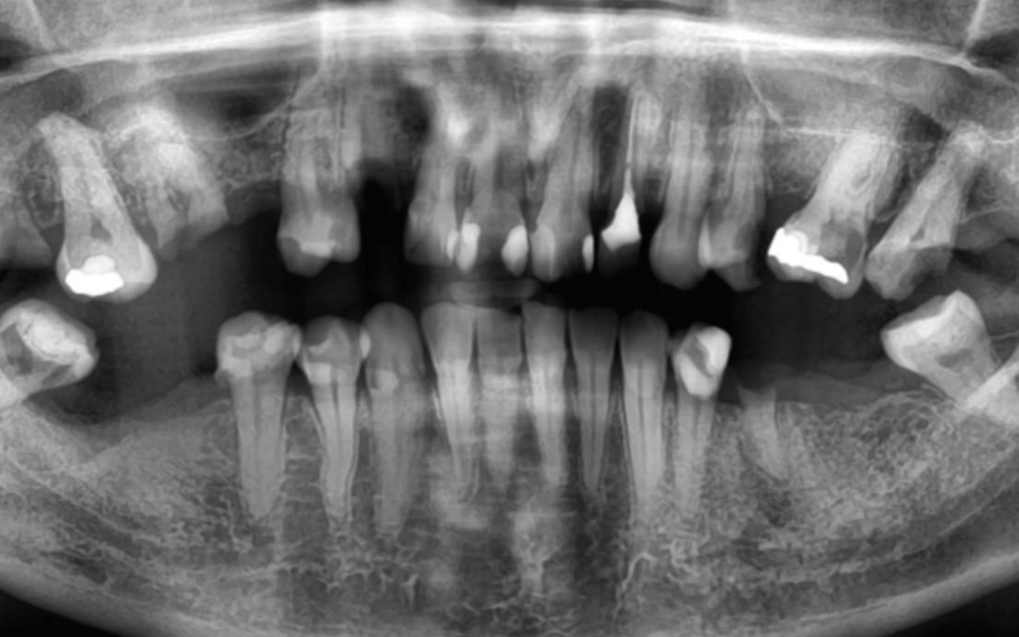 
        Zdjęcie rentgenowskie zębów, ukazujące szczegóły uzębienia.
    