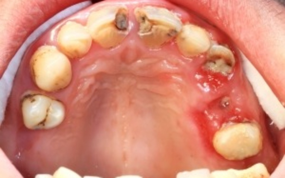 
        Zdjęcie zębów z problemami zdrowotnymi, wymagających leczenia.
    